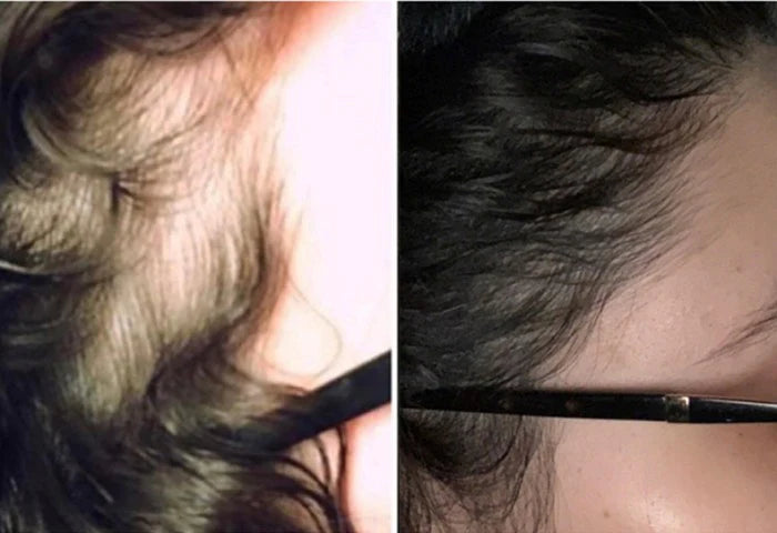 alopecia, traction alopecia, hair loss, hair growth oil, righteous roots oil, jamaican black castor, hair thinning, post partum hair loss